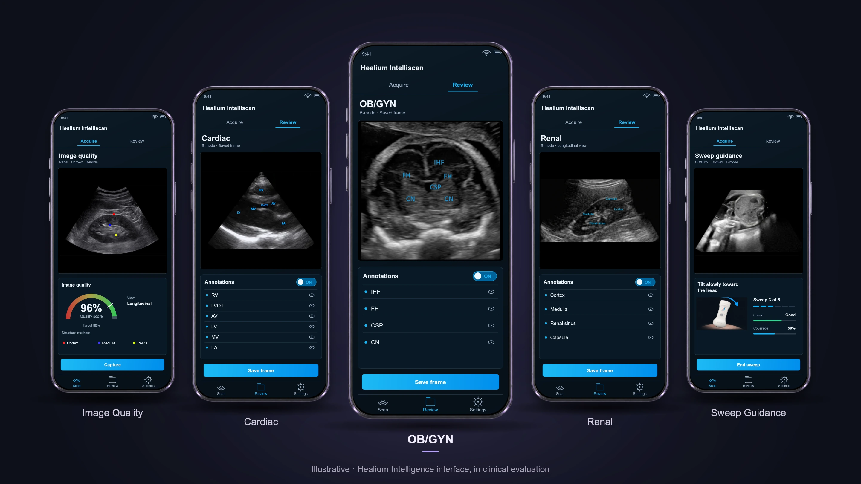 Illustrative Healium Intelligence interfaces on five phones, in clinical evaluation: Image Quality, Cardiac, OB/GYN, Renal and Sweep Guidance
