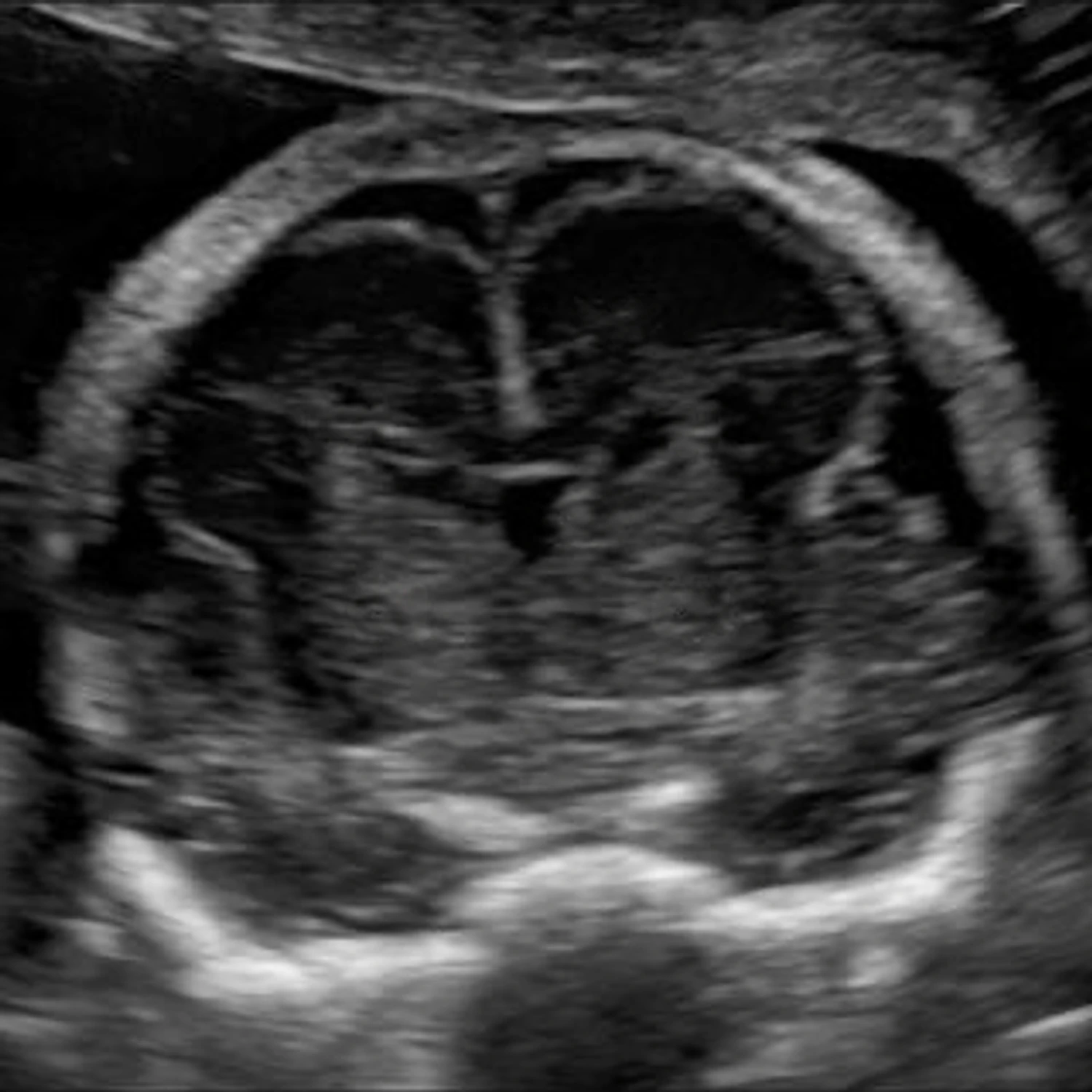 OB/GYN B-mode frame from the convex array